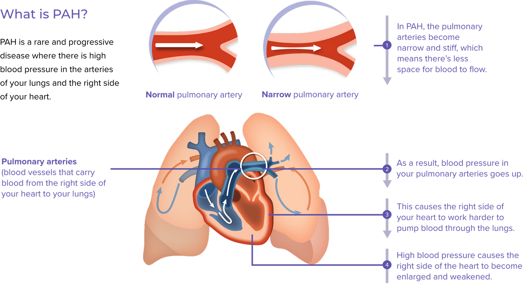 Illustration explaining how PAH is a disease where there is high blood pressure in the arteries of your lungs, which causes the heart to work harder, becoming enlarged and weakened